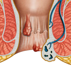 Piles Fissure Fistula