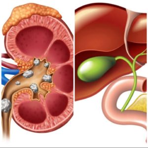 Kidney & Gall Bladder Stone