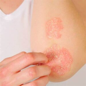 Skin Diseases