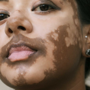 Vitiligo